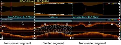 Prognostic value of optical flow ratio for cardiovascular outcomes in patients after percutaneous coronary stent implantation